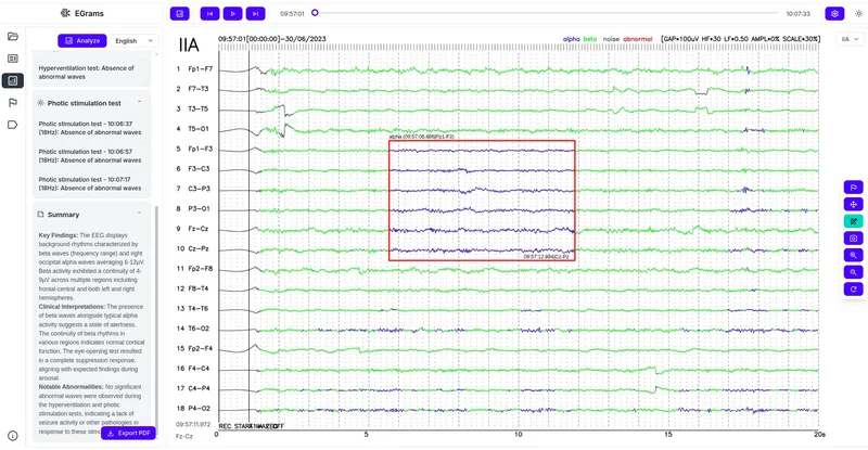 EEG CDAs
